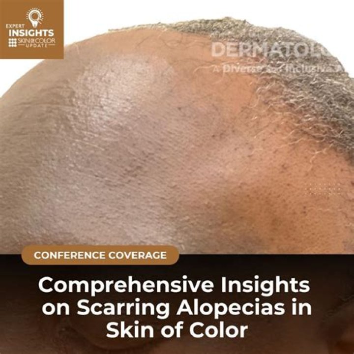 Discoveries And Insights Into Alopecia And Confidence