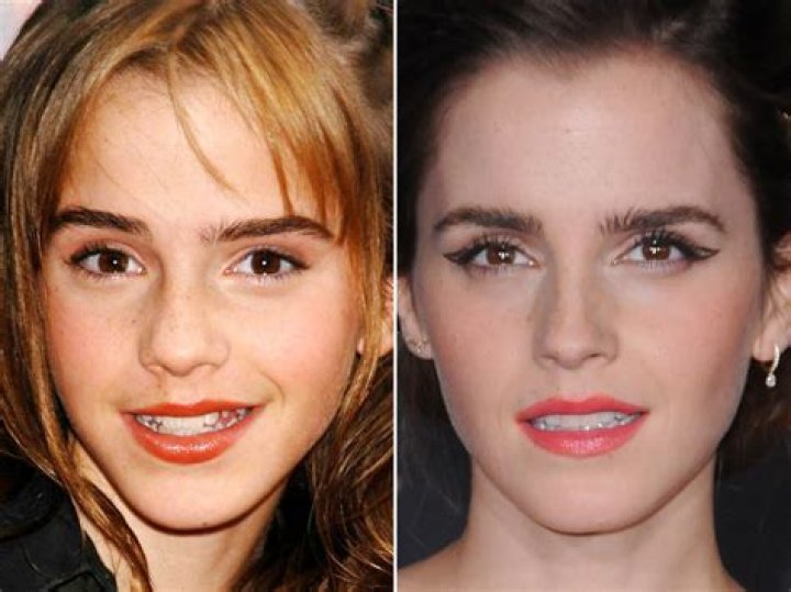 Emma Watson's Nose Surgery Journey