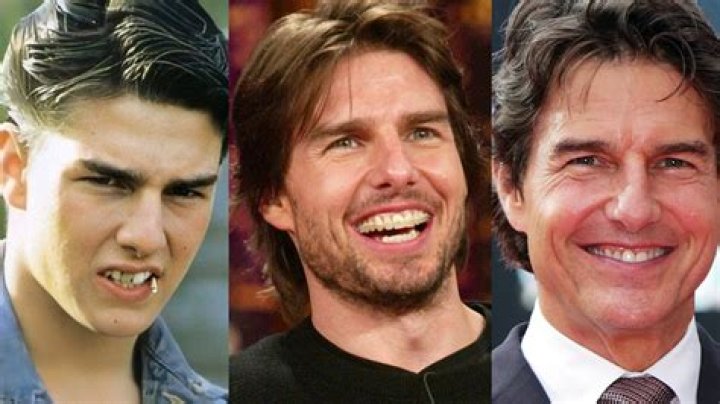 Uncover The Evolution Of Tom Cruise's Smile: A Dental Journey Revealed